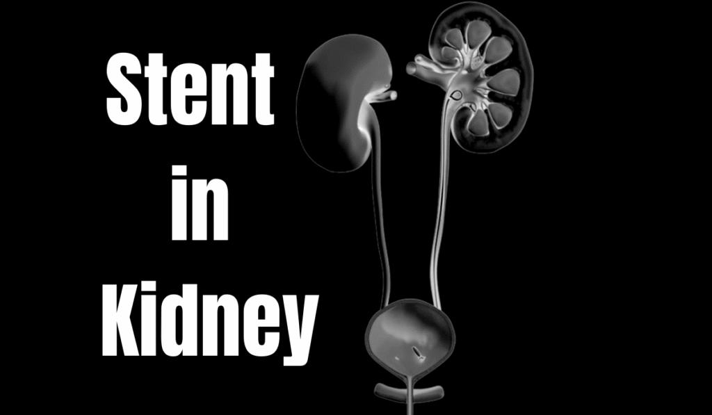 STENT IN KIDNEY