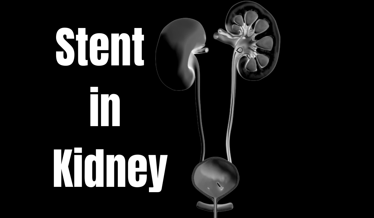 What You Need to Know About Stent in Kidney | Littlemedi.com