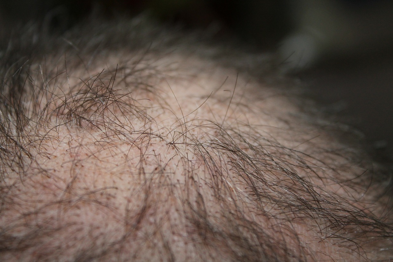 How Much Is Hair Transplant 