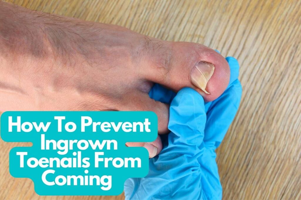 How To Prevent Ingrown Toenails From Coming