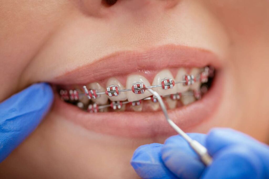 How to Remove Stains From Braces